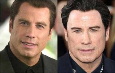 John Travolta’s Botox and Facelift